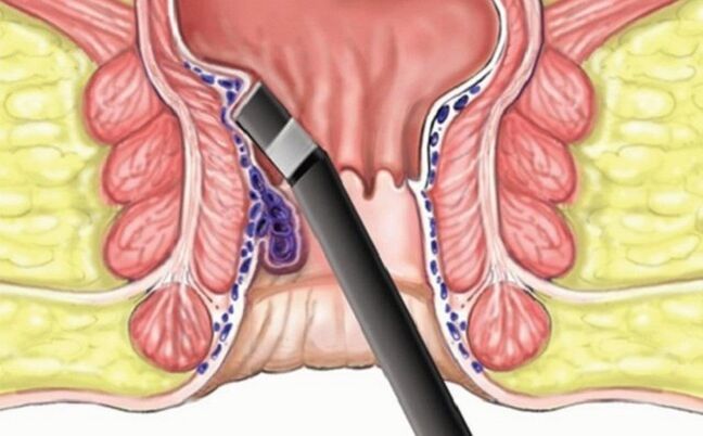 Koagulatioun vun Hämorrhoiden bei Hämorrhoiden